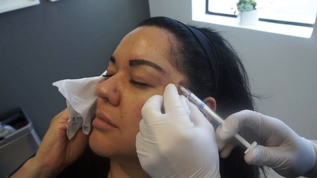 Radiesse Soft Tissue Temple Augmentation / Filler To Forehead / Eyebrow Lift Non Invasive смотреть онлайн