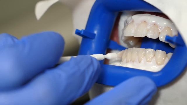 Teeth Whitening At The Dentist | Fastest Way To Whiten Your Teeth