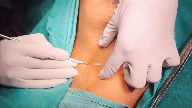 Sentinel Lymph node biopsy for Breast Cancer using ICG by Dr Vipin Goel смотреть онлайн