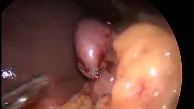 Bilroth II Gastrectomy for Pre Pyloric GIST смотреть онлайн