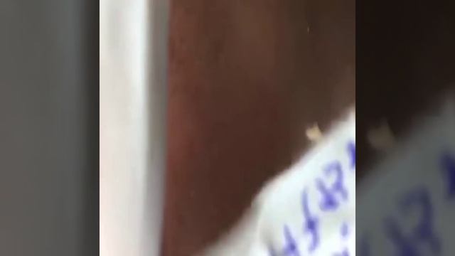 Best Pimple Popping Video #2