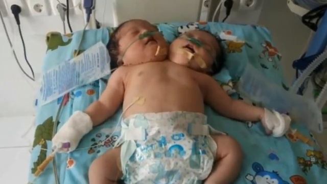 B УЗБЕКИСТАНЕ РОДИЛИСЬ СAМЫЕ НEОБЫЧНЫЕ СИАМСКИЕ БЛИЗНЕЦЫ хлеб смотреть онлайн