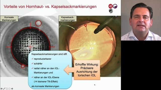 Katarakt-OP: Automatisierte FLACS Markierung und individuelle torische Introkularlinsen [Vortrag] смотреть онлайн
