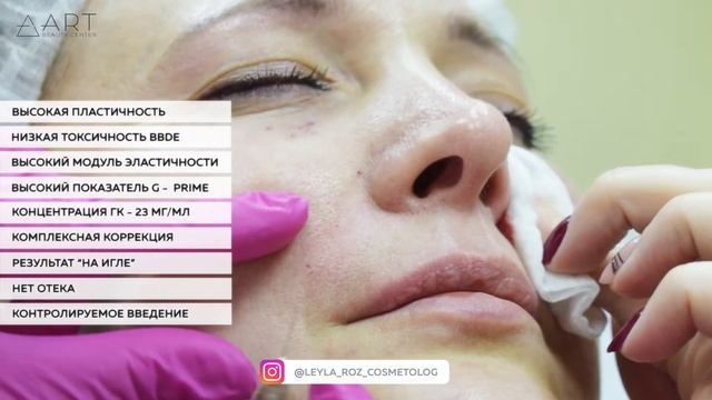 DELIGHT Classic - коррекция носогубных складок смотреть онлайн