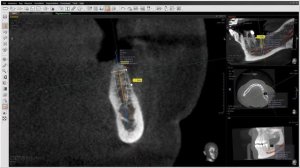 Планирование имплантации в программе EZ3D2009