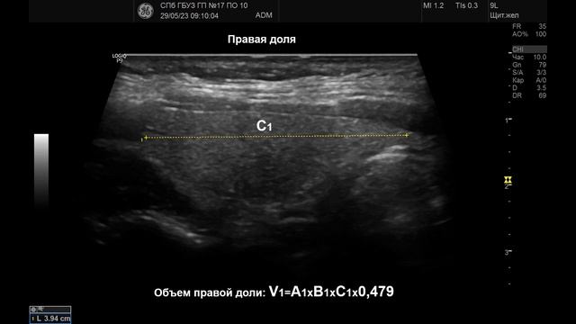 УЗИ. Доктор Иогансен. Видеопримеры. Выпуск 18. Методика УЗИ щитовидной железы. смотреть онлайн