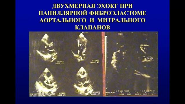 Лекция: Опухоли сердца смотреть онлайн