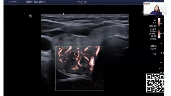 Как на практике применять систему отчетности TI-RADS врачу УЗД?