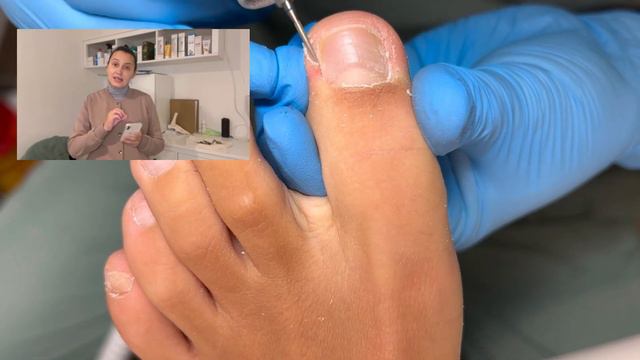 Околоногтевые мозоли. Подробное видео. Как удалять и чем. смотреть онлайн