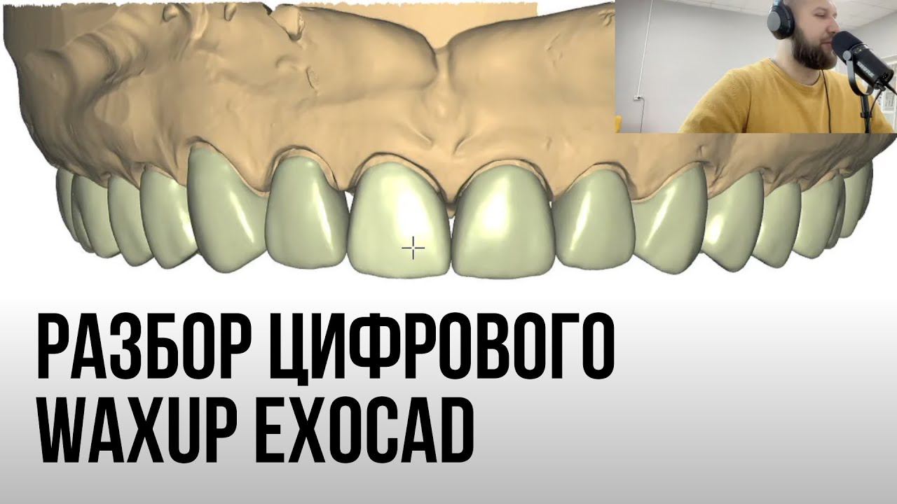 Разбор цифрового Waxup Exocad