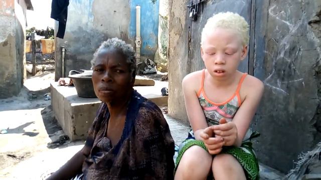 Albinism on focus смотреть онлайн