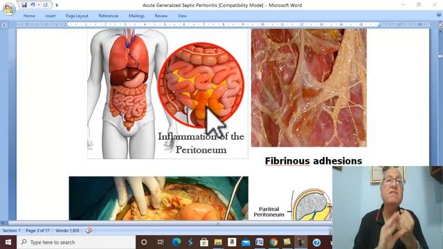 Peritoneal Disorders in Arabic 1 (Acute Generalized Septic Peritonitis ) , by Dr. Wahdan смотреть онлайн