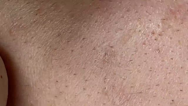 Захватите прыщи, скрытые глубоко под кожей смотреть онлайн