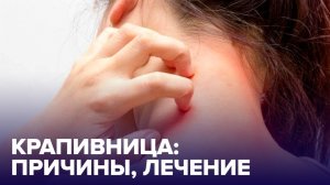 КРАПИВНИЦА: чем опасна и как ЛЕЧИТЬ