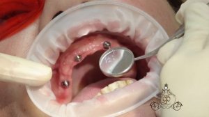 Несъемный протез на четырех имплантатах all-on-4   - что делать, если нет зубов?