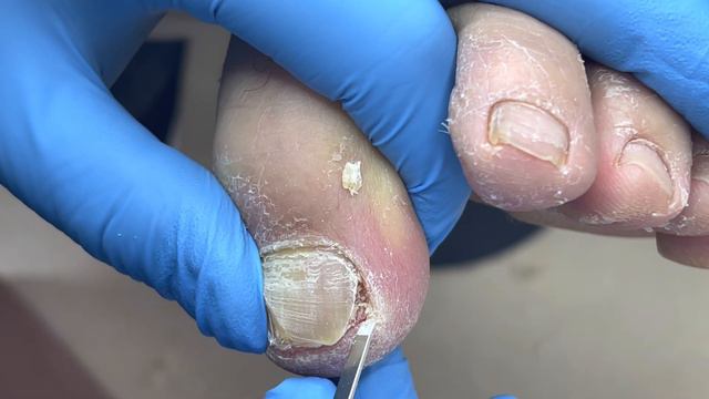 Very thick nails, the pliers keep cutting【Foot Scalpel】 смотреть онлайн