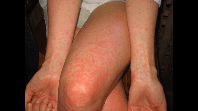 Скарлатина симптомы смотреть онлайн