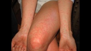 Скарлатина симптомы