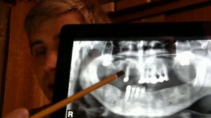 Зубные протезы день 1