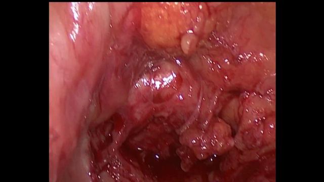 Некроз мочеточника нефротрансплантата смотреть онлайн