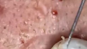 Выдавливание чёрных точек