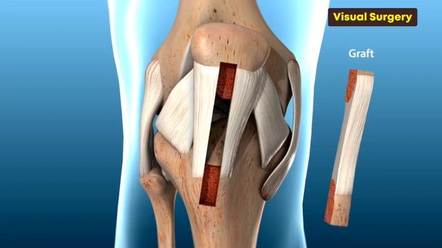 ACL (Surgery)- Knee Ligament Surgery ACL Repair - 3D Animation смотреть онлайн