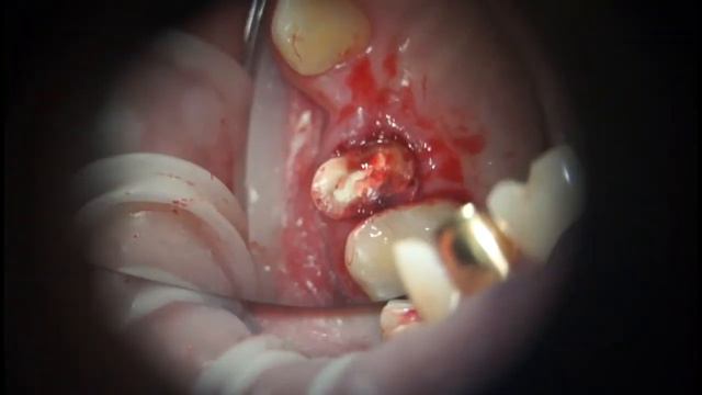PET technique - alternative to crown lenghtening смотреть онлайн