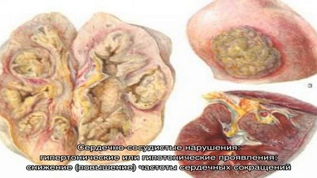 Карбункул в почке и его лечение смотреть онлайн