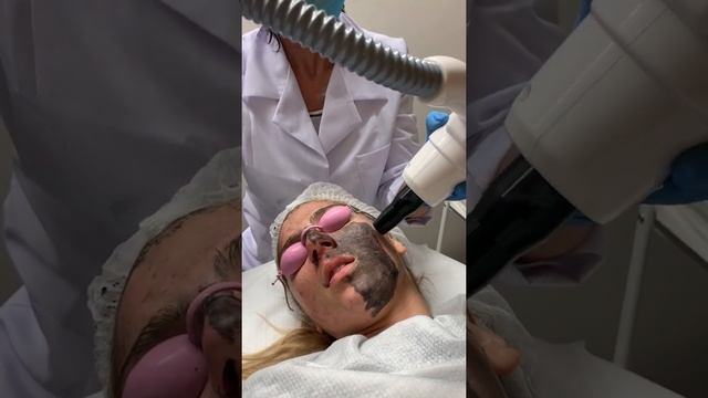 Карбонов пилинг с Nd:Yag лазер смотреть онлайн