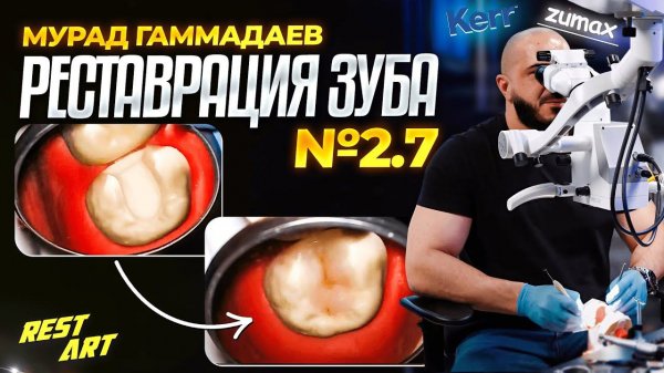 Реставрация зуба 2.7 - Мурад Гаммадаев | RestART