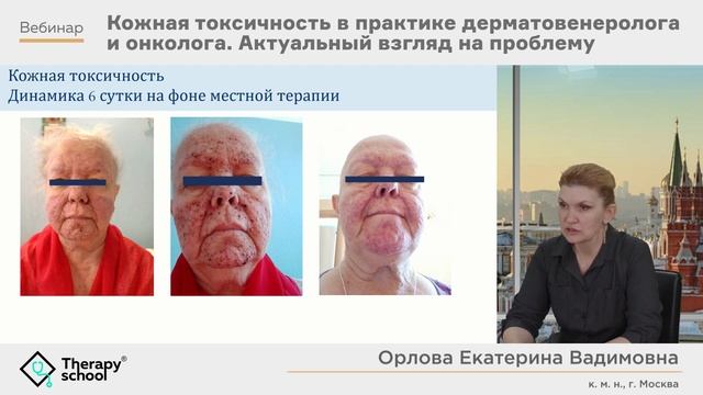 Кожная токсичность в практике дерматовенеролога и онколога. Актуальный взгляд на проблему смотреть онлайн