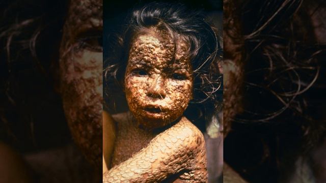 Smallpox | Wikipedia audio article смотреть онлайн