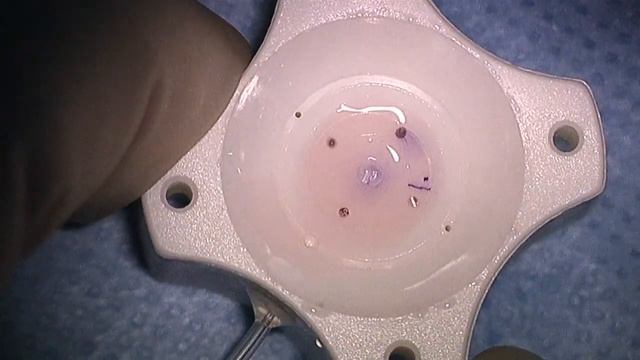 Small Incision Dsaek