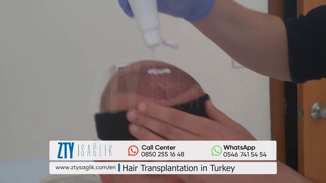 Hair Transplantation in Turkey😷😍🇹🇷 смотреть онлайн