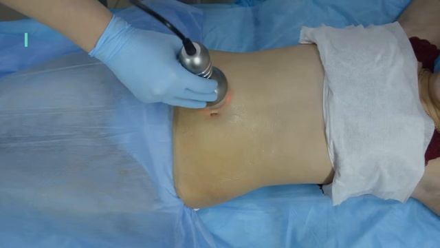 RF лифтинг тела смотреть онлайн