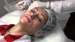 Субдермальные вколы биоревитализантом