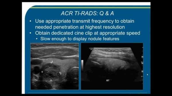 ACR TI-RADS Webinar Part II: Case Based Review & Frequently Asked Questions