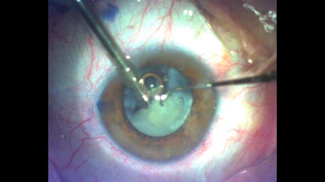 Oculentis Comfort 1.8 MICS ,mature Cataract Dr.Mishev