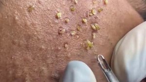 Удаление черных точек 2022 EP 05