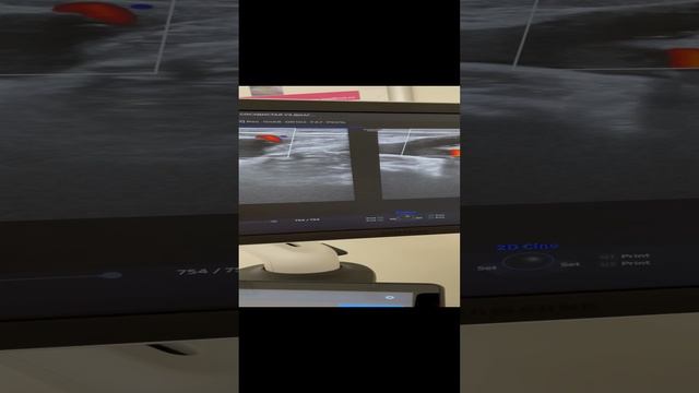 Лечение варикоза лазером. ЭВЛК. Рецидив варикоза. Сосудистая сетка. Флеболог Москва. Флеболог смотреть онлайн