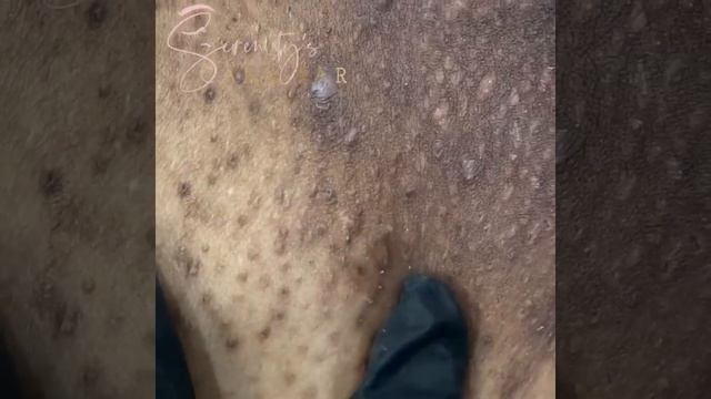 Blackheads, Ingrown hair , and Cop Stories смотреть онлайн