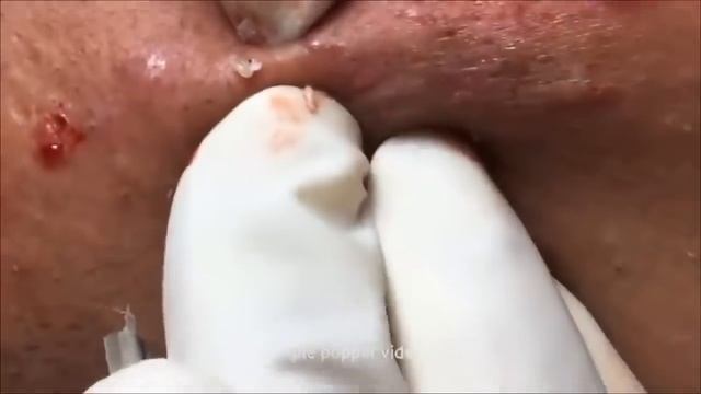 ВЫДАВЛИВАЕМ БОЛЬШИЕ ЧЕРНЫЕ ТОЧКИ