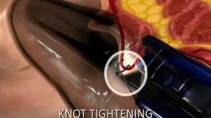 Дезартеризация геморроидальных узлов (ДГУ)