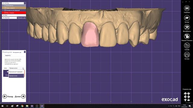 Вкладка, винир exocad смотреть онлайн