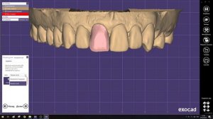 Вкладка, винир exocad