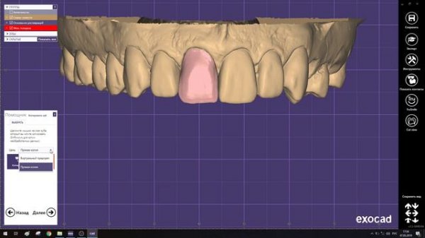 Вкладка, винир exocad