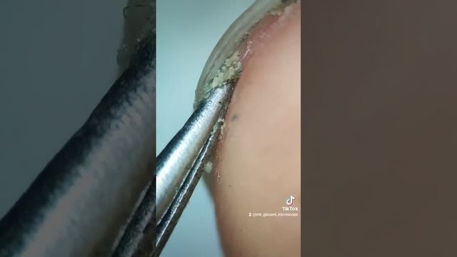 НОГТИ ПОД МИКРОСКОПОМ смотреть онлайн