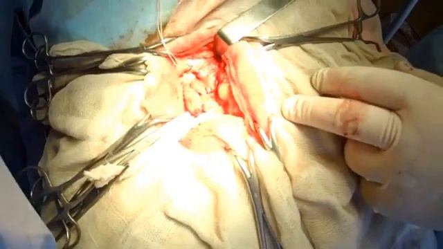Inguinal Hernia Repair.Паховое грыжесечение. смотреть онлайн