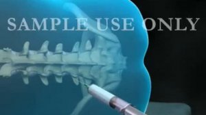 Эпидуральная и спинальная анестезия