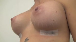 Bröstförstoring 525 g efter 1 vecka på Nackakliniken Plastikkirurgi Boob job Dr Gustav Aniansson